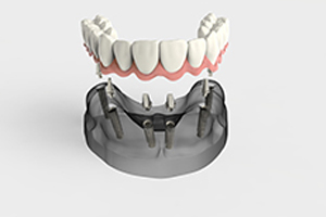 Reabilitação fixa de desdentados totais com implantes dentários